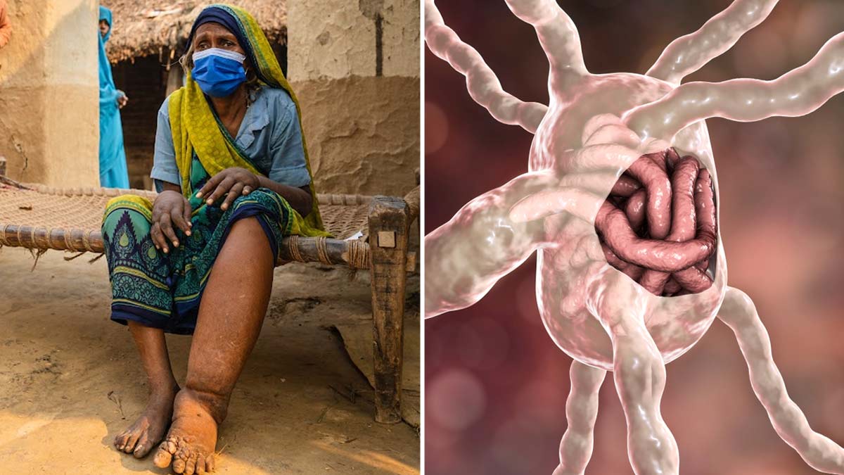 Rare Disease Elephantiasis: What Is This Condition That Causes Enlargement Of Body Parts